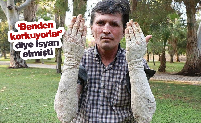 23 yıldır hastalıkla mücadele ediyordu... İşte son hali!