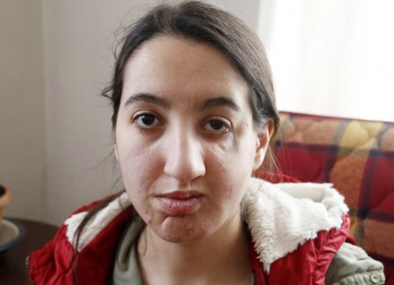 'YÜZÜMÜN DÜZELMESİNİ İSTİYORUM' 'YÜZÜMÜN DÜZELMESİNİ İSTİYORUM'