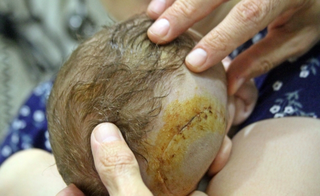 1 aylık bebek pusetten düştü kafatası kırıldı! 1 aylık bebek pusetten düştü kafatası kırıldı!