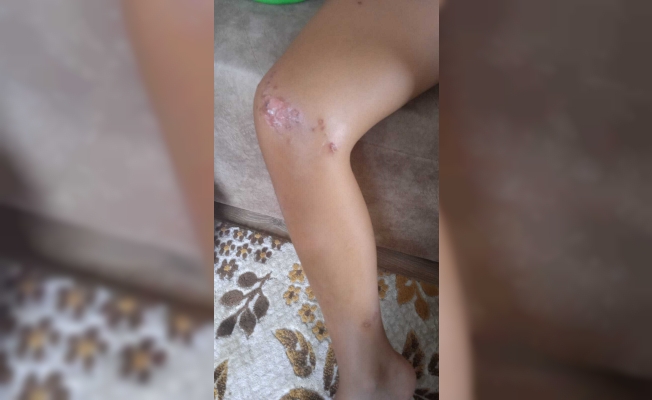 9 yaşındaki çocukta deniz kaynaklı enfeksiyon şüphesi