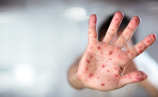 5 yaş altı çocuklar risk altında