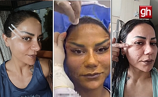 "220 Bin TL'lik estetik 3 gün dayanamadı! Sonuç şoke etti!"