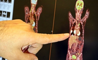 "Akciğer kanseri tedavisinde sağ kalım oranları artıyor"